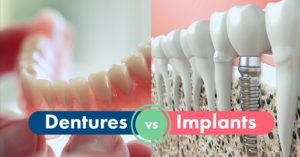 Dentures vs Implants graphic