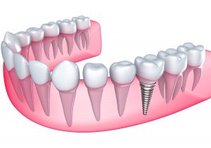 Discover the Benefits of Dental Implants for Missing Teeth in Paxton, MA Area