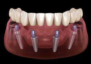 Implant-Supported Dentures in Paxton MA Area