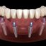 Implant-supported dentures for replacing missing teeth
