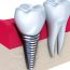 Risks associated with not replacing missing teeth with implants