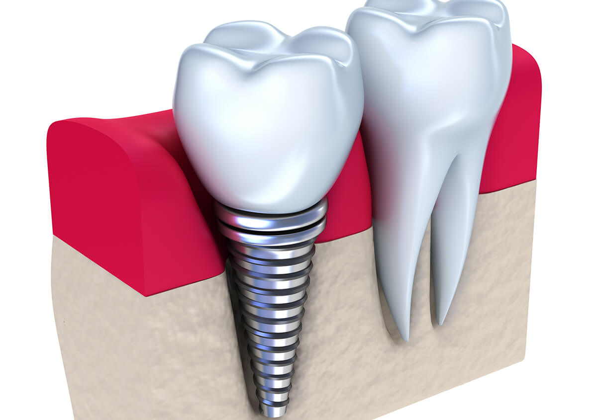 Replacing Crooked Teeth With Implants in Paxton MA Area