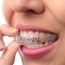 The Benefits of Candid Pro Invisible Dental Aligners Cannot Be Matched!