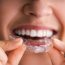 A Look into How Candid Pro Clear Aligners Separate Themselves from Traditional Orthodontics