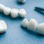 Here’s What You Need to Know About CEREC Same-Day Dental Crowns!