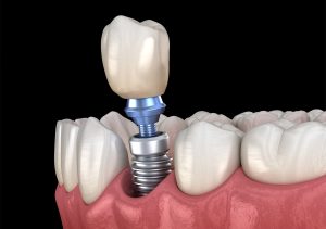 Affordable Dental Implants in Paxton MA Area