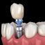 Reasons Why Dental Implants May Be More Affordable Than You Believe