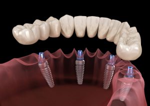 Implant Supported Dentures in Paxton MA area