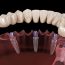 Benefits To Consider If You Are Considering The Switch From Traditional To Implant Supported Dentures